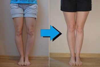leg-before-after-1
